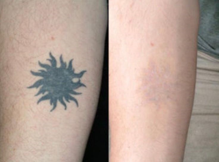 Laser-Tattoo-Removal